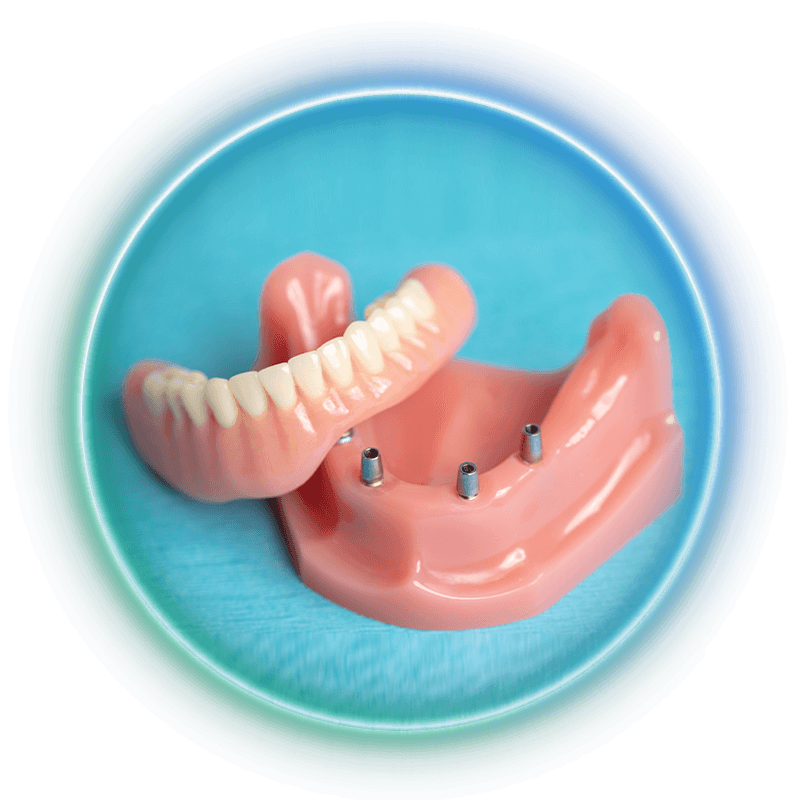 implant supported dentures