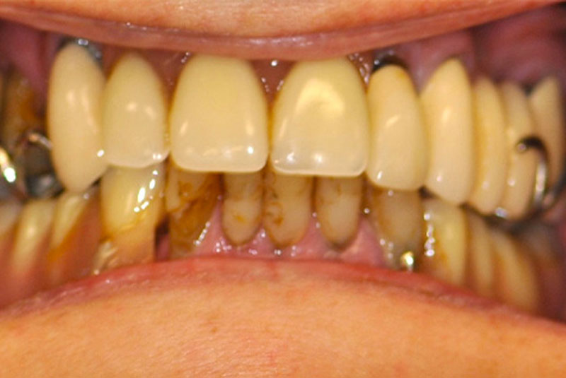 lifetime denture before