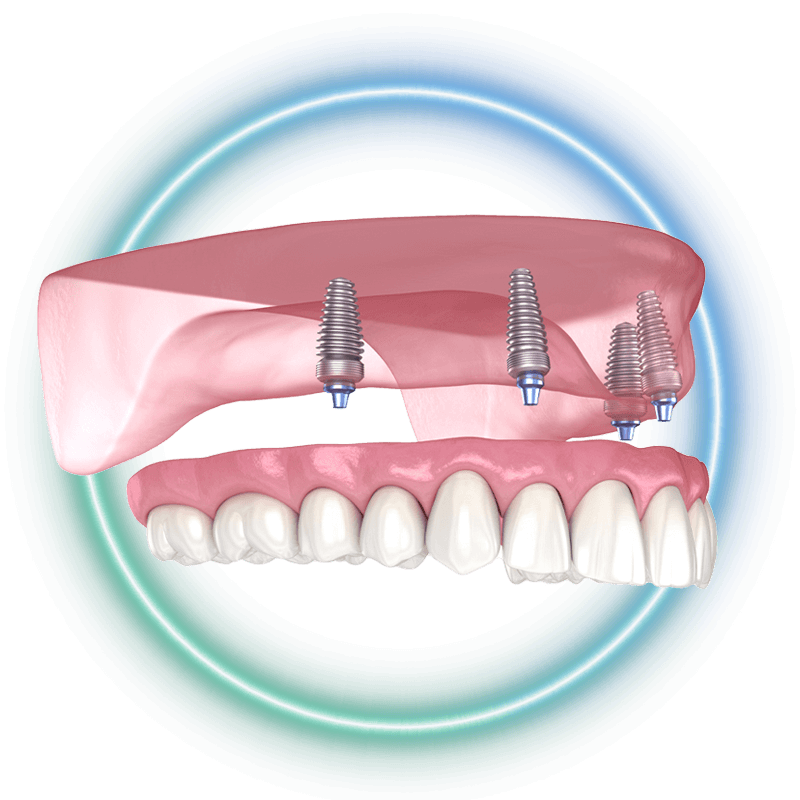 zirconia fixed bridge model stylized1