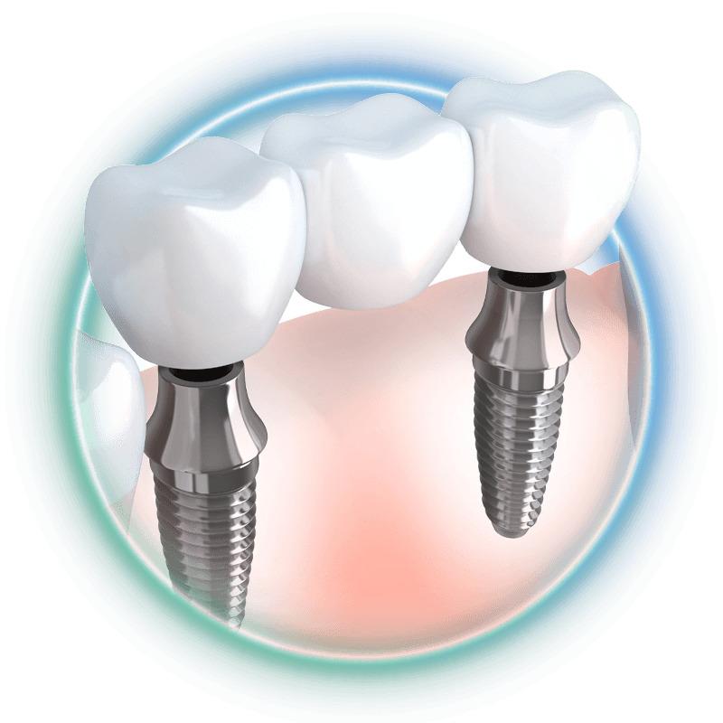 crown and bridge stylized missing tooth1