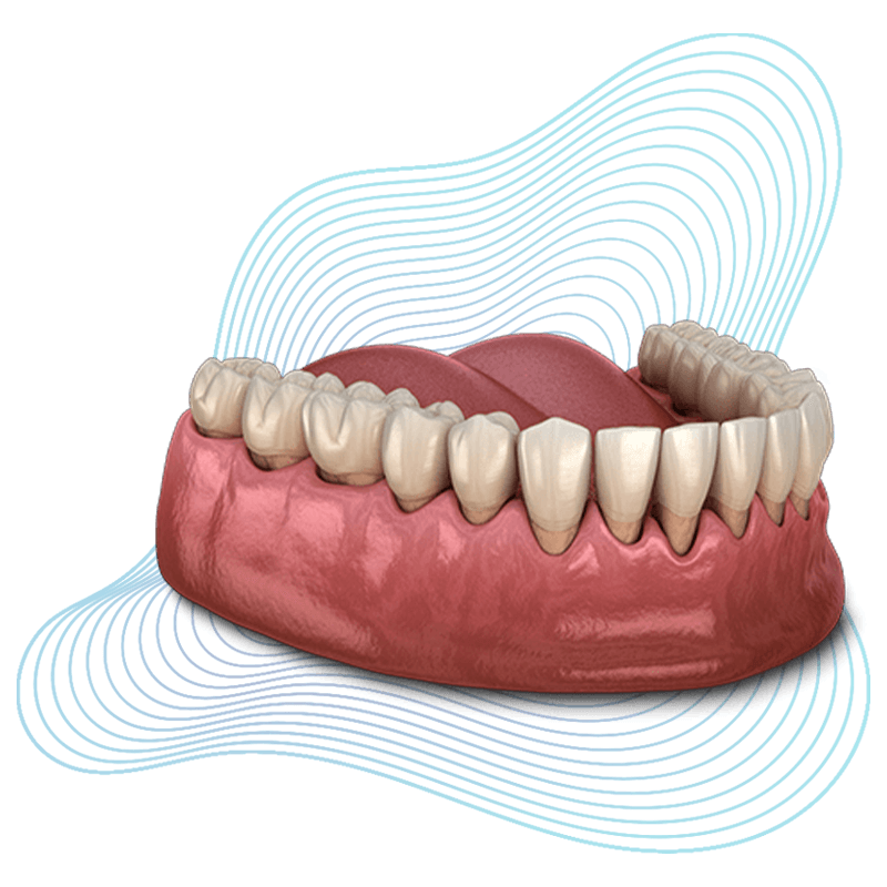 gum recession disease 3dmodel1