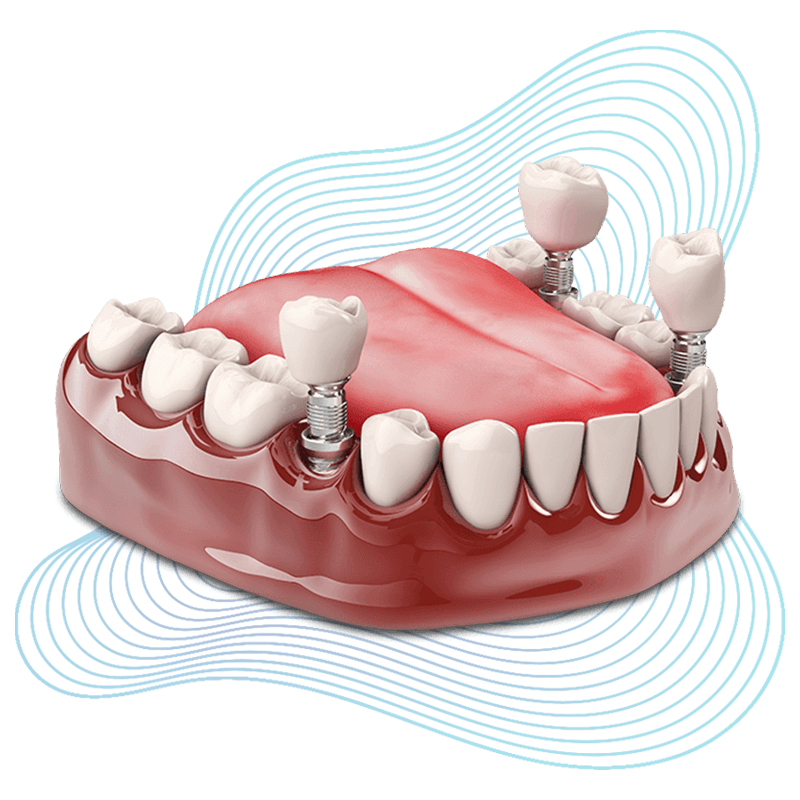 surgical implant stylized1