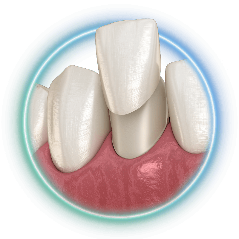 veneer popping outstyilized