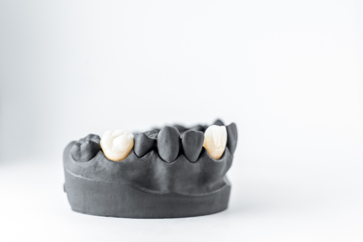 essential tips to extend the lifespan of your dental crowns and bridges