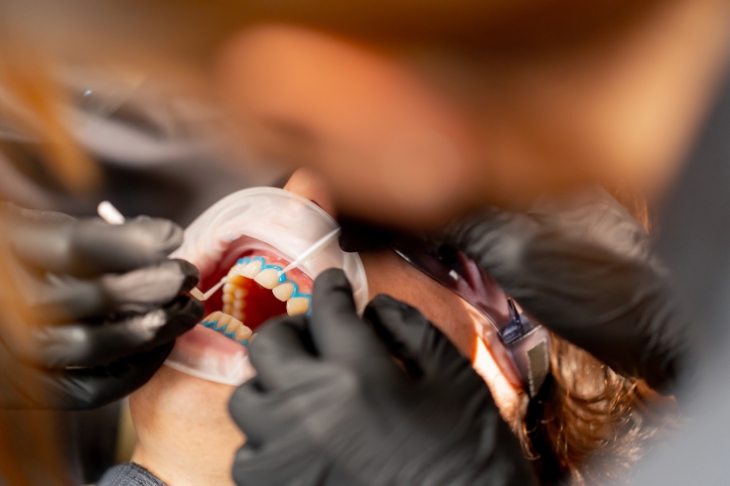 how long does a composite filling last