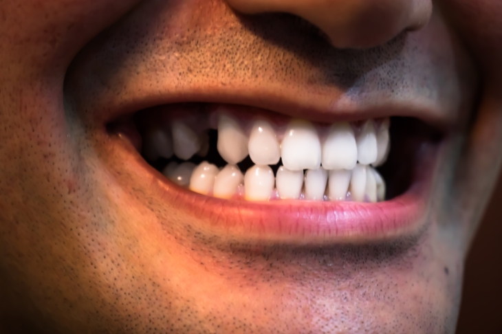do not ignore a broken tooth