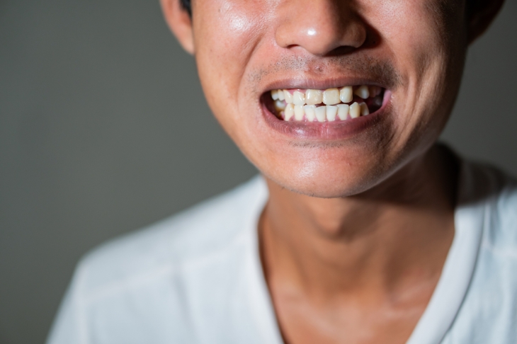 effective ways to remove stains from the back of your teeth