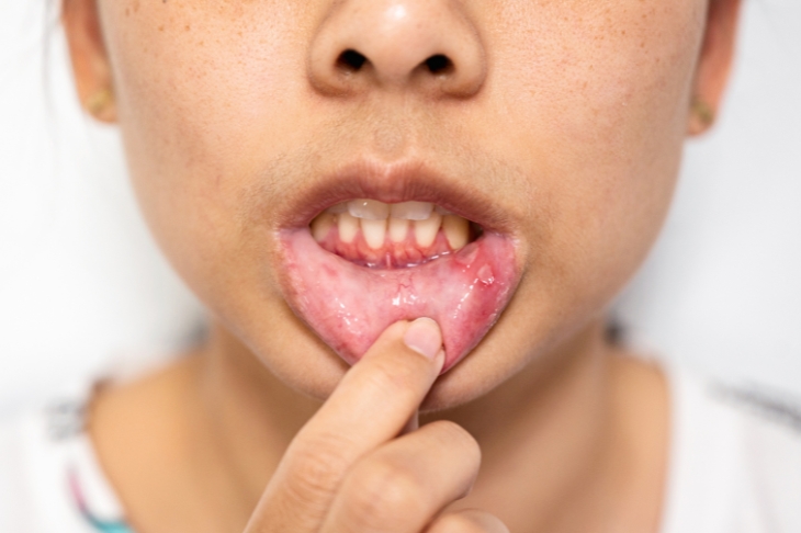 get rid of gum infection